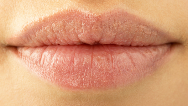 Trockene, rissige Lippen im Winter: Ursachen und Pflege