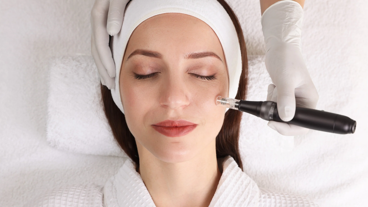 Nahaufnahme einer Frau bei einer Microneedeling Behandlung
