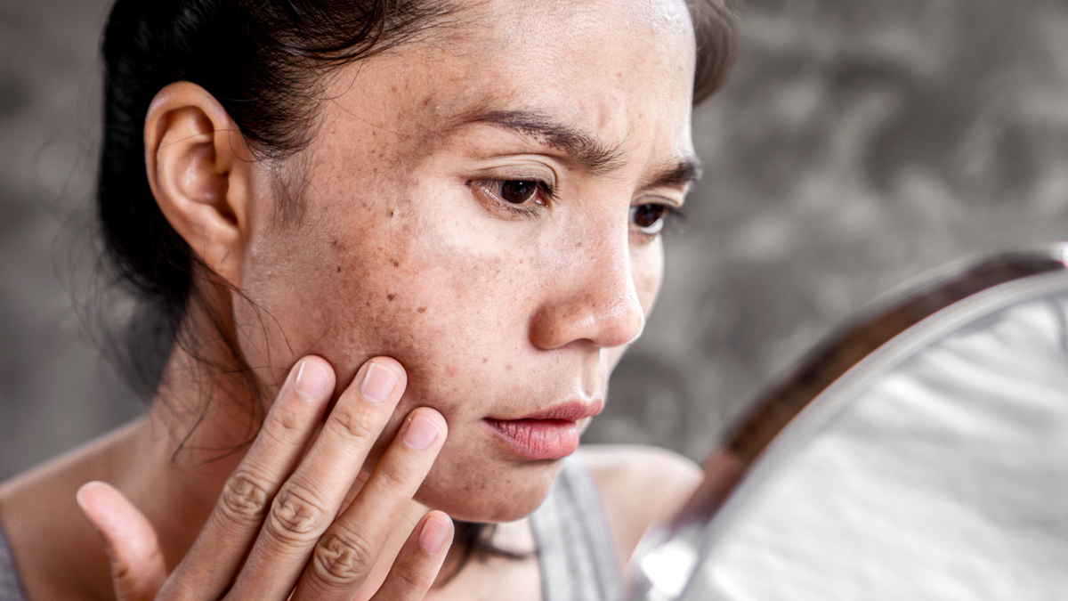 Melasma im Gesicht – Ursachen, Pigmentflecken und Behandlung erklärt