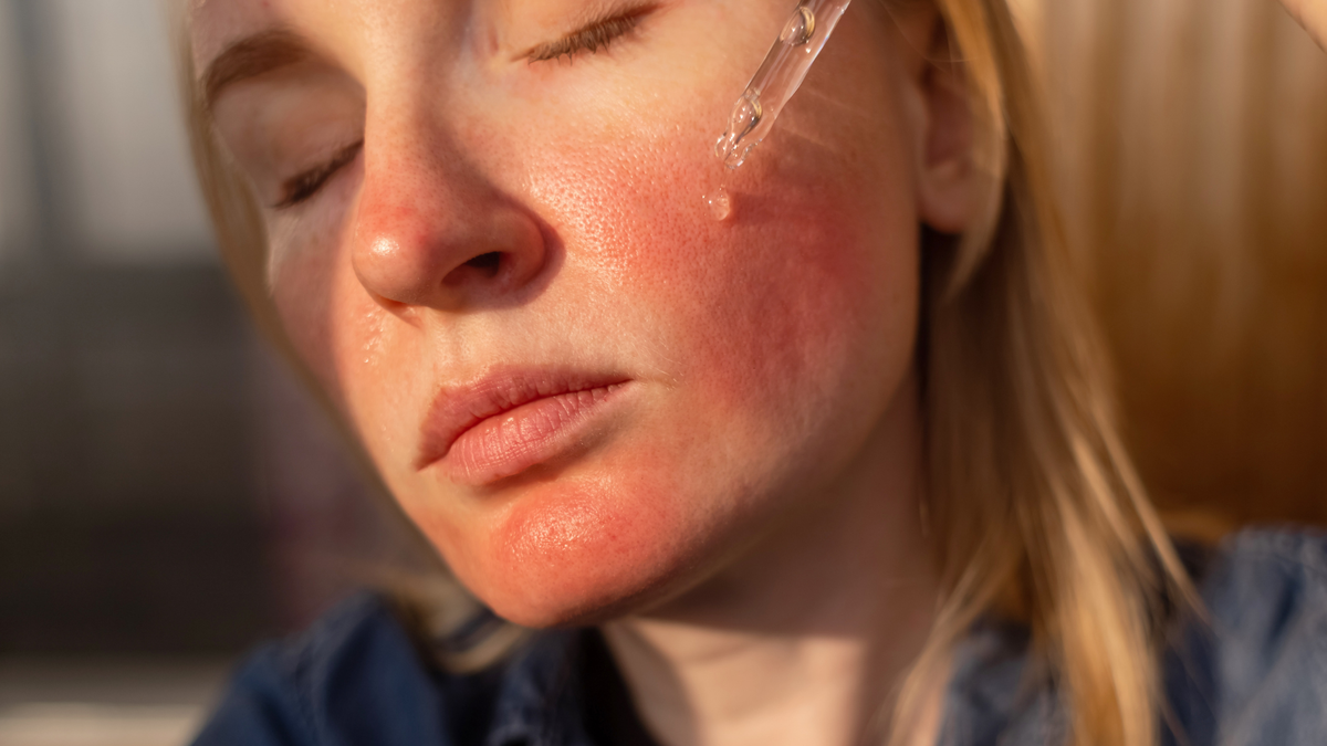 Junge frau mit Rötungen im Gesicht trägt mit einer Pipette ein Serum auf